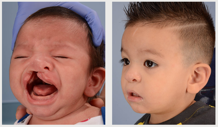 cleft lip and palate