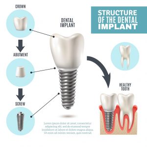 dental-implants-300x300